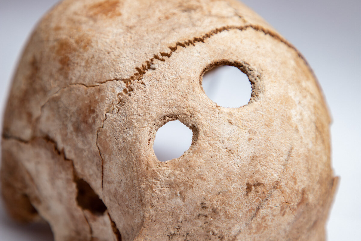 In der nordöstlichsten keltischen Siedlung Europas wurde ein Skalpell gefunden, mit dem Druiden vor 2300 Jahren Operationen am Schädel durchführten.